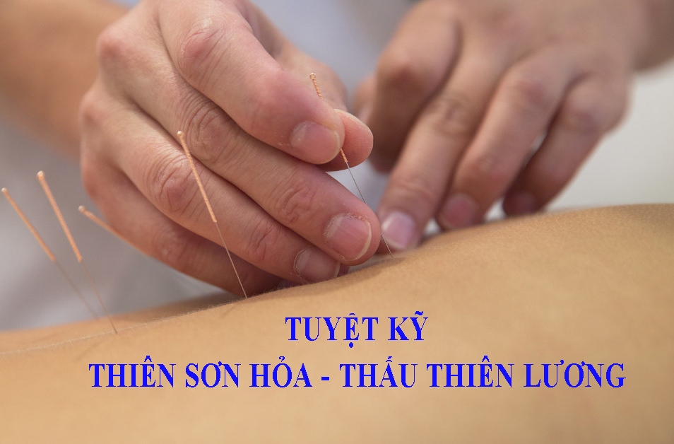 Tuyệt kỹ THIÊN SƠN HỎA – THẤU THIÊN LƯƠNG – TS.BS NGÔ QUANG HẢI