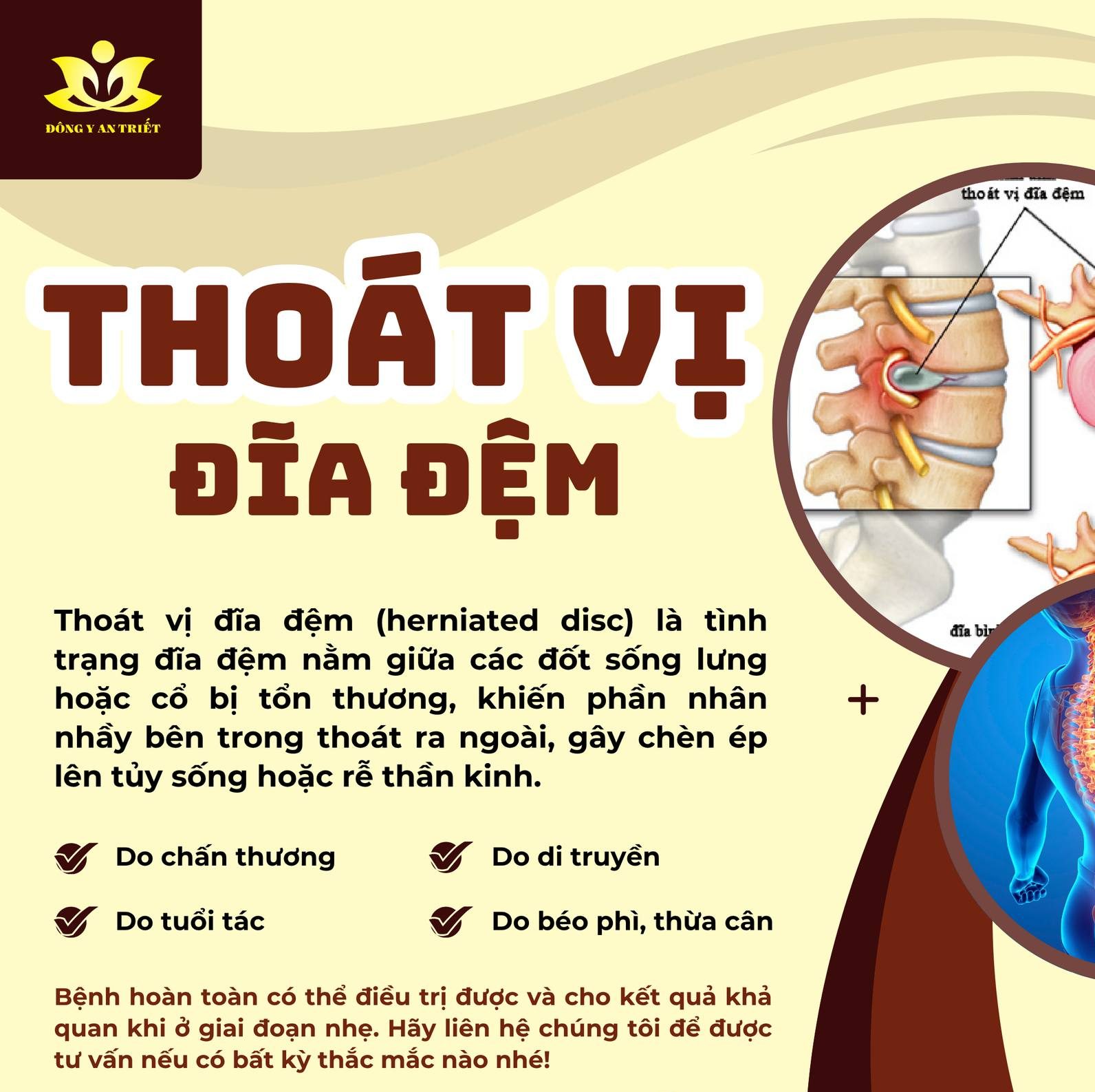 THOÁT VỊ ĐĨA ĐỆM CÓ CHỮA ĐƯỢC KHÔNG?